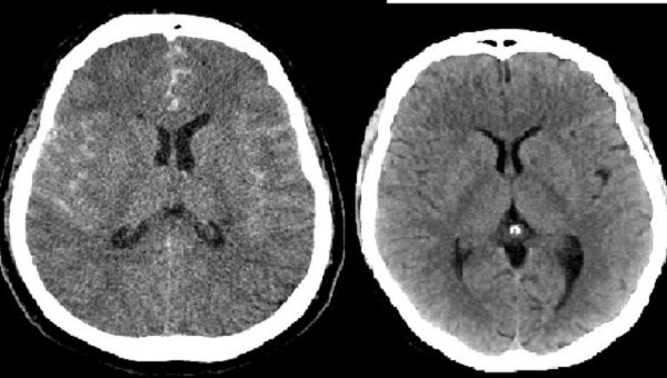 Bên trái: Xuất huyết não dưới nhện. Bên phải: CT scan sọ não bình thường