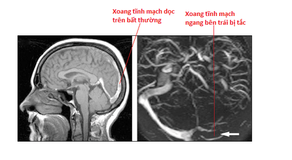 Bên trái: MRI não ghi nhận bất thường ở xoang tĩnh mạch dọc trên. Bên phải: MRI mạch máu ghi nhận tắc nghẽn xoang tĩnh mạch ngang bên trái.