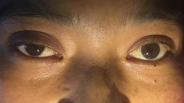 Co đồng tử (tròng đen) kèm sụp mi bên mắt phải của bệnh nhân trong hội chứng Horner
