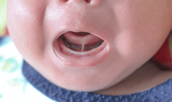 Dính thắng lưỡi ở trẻ sơ sinh