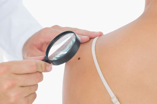 Nốt sắc tố nhỏ ở da (có thể nhầm với nốt ruồi) cũng có thể là biểu hiện sớm hội chứng cận ung thư