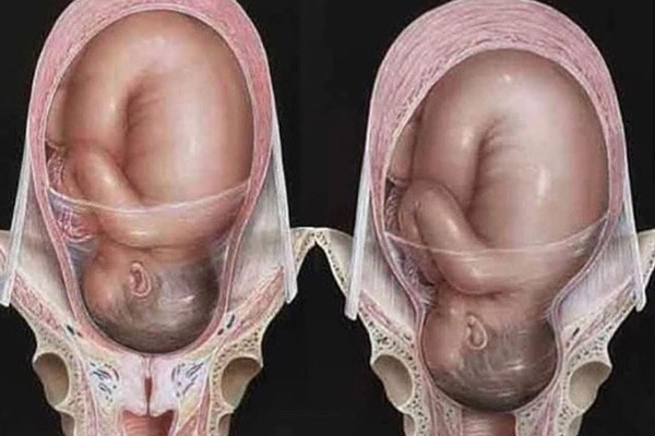 Hở eo tử cung khi mang thai