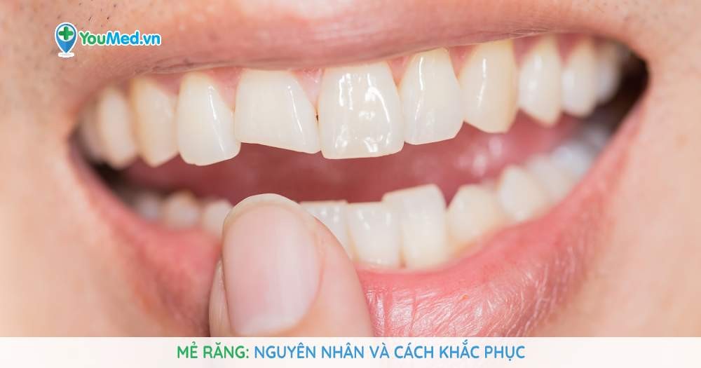 Mẻ răng: Nguyên nhân và cách khắc phục