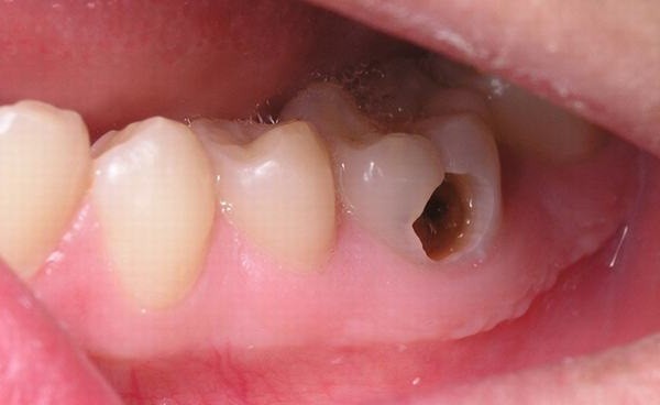 Nếu không ngừa mảng bám, bạn có thể bị sâu răng