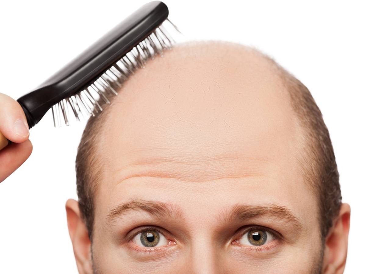 Rụng tóc ở tuổi dậy thì Nguyên nhân  cách chữa trị dứt điểm