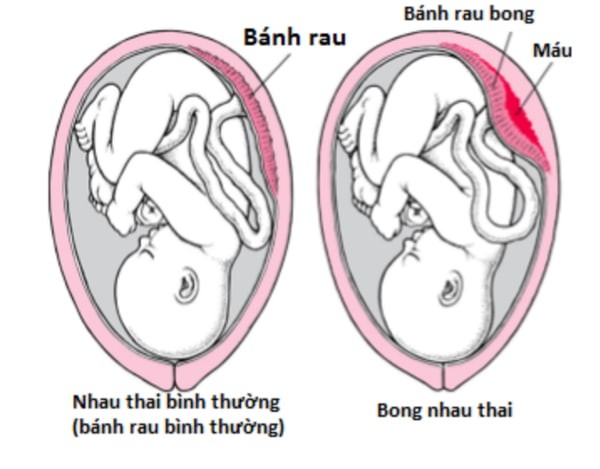 Máu chảy tụ lại nằm giữa bánh nhau và tử cung gọi là nhau bong non