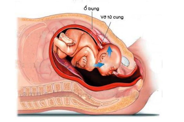 Vỡ tử cung: Máu tụ bị che lấp bởi các cấu trúc trong khung chậu mẹ