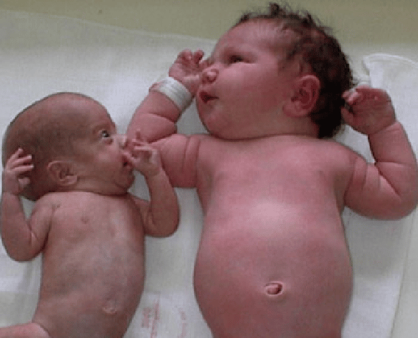  Hai trẻ cùng tuần thai. Trẻ bên trái bị IUGR
