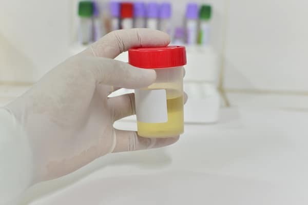 Xét nghiệm nước tiểu để xác định bạn có bị nhiễm trùng tiểu hay không 