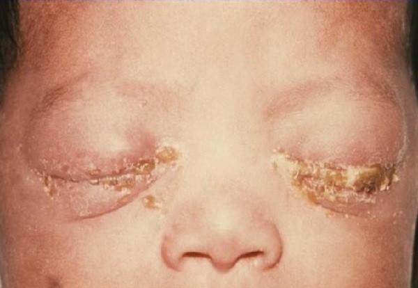 Trẻ sơ sinh bị mù mắt do mẹ bị viêm cổ tử cung do lậu