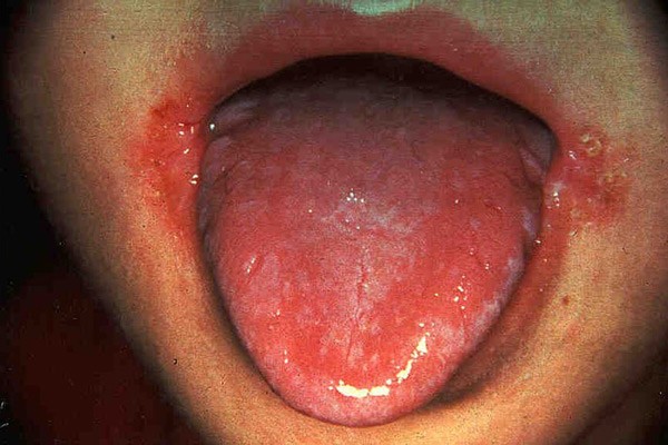 Viêm lưỡi và khóe miệng ở trẻ thiếu vitamin B2
