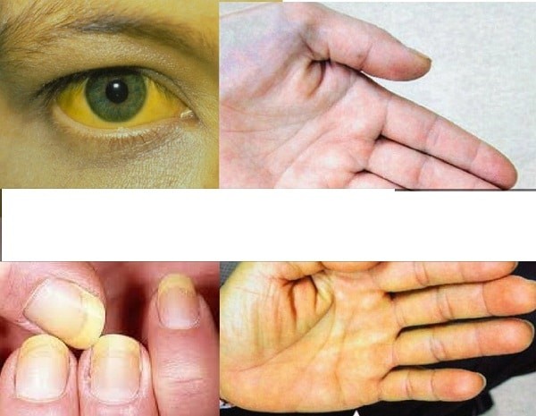 Vàng da, vàng mắt là những triệu chứng điển hình của u tụy nội tiết