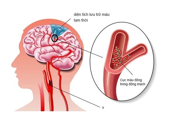 cục máu đông làm tắc nghẽn lưu thông máu đến não