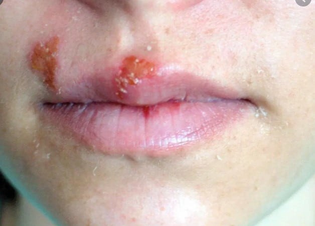 Tổn thương do herpes ở môi