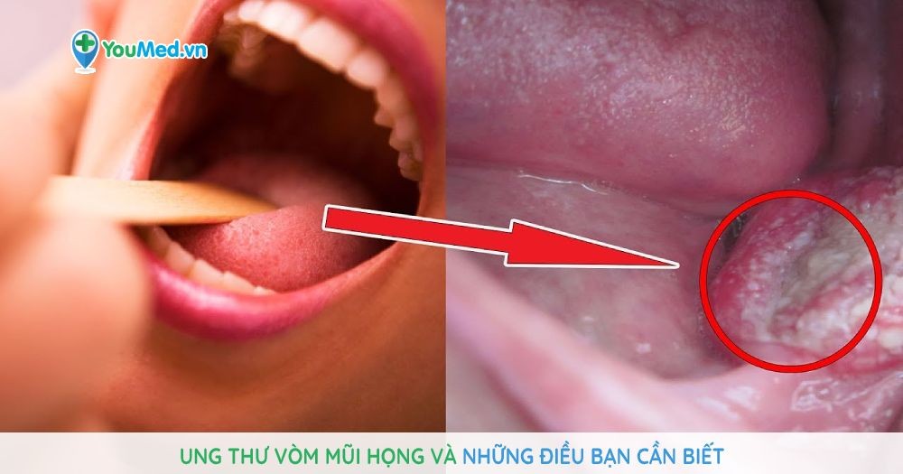 Ung thư vòm mũi họng: nguyên nhân, triệu chứng và cách điều trị