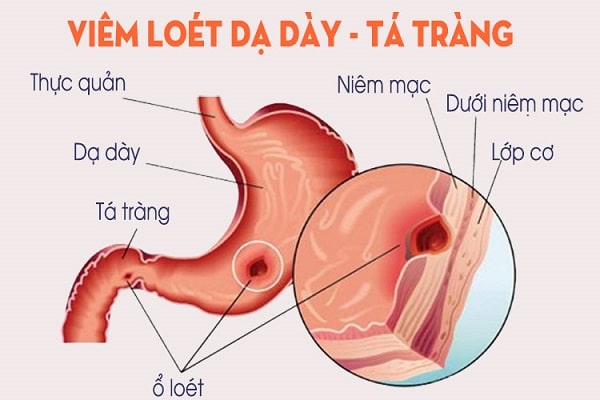 Loét dạ dày tá tràng