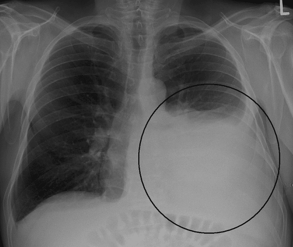 X- quang tràn dịch màng phổi