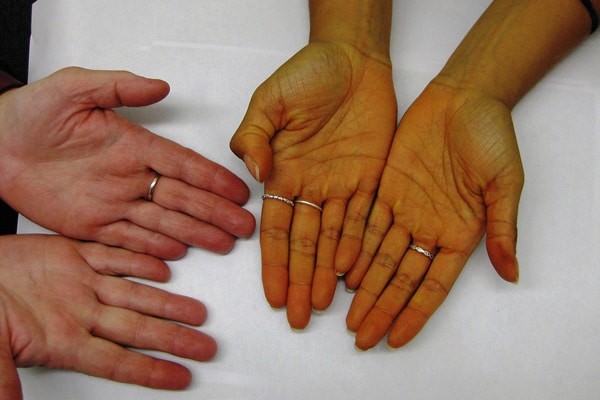 Triệu chứng vàng da có thể xuất hiện trong bệnh Wilson hoặc nhiều bênh lý khác nữa
