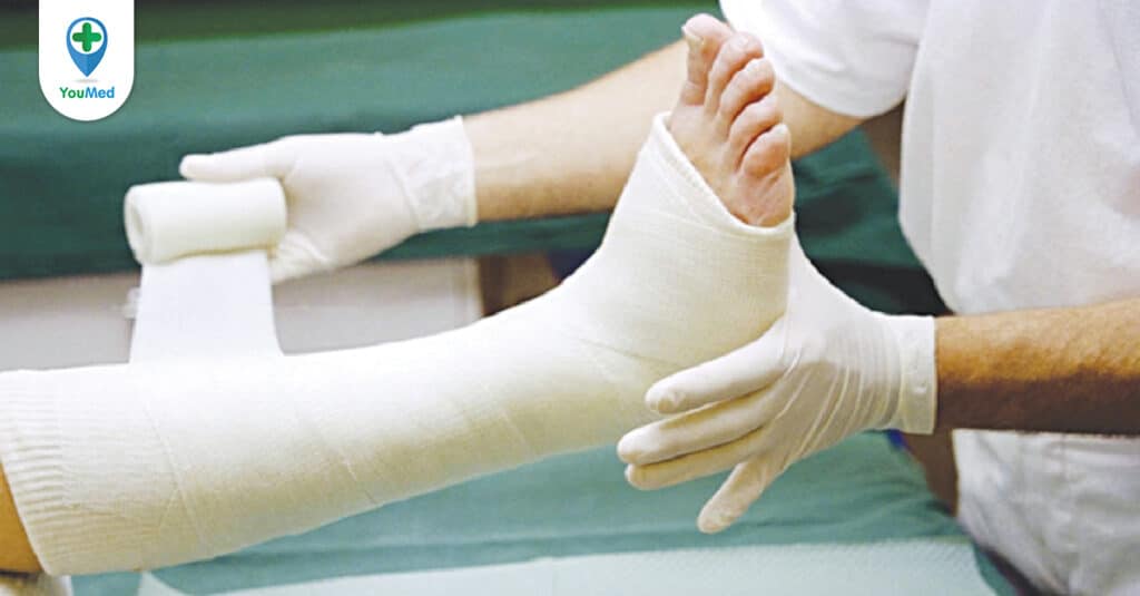 Bó bột sau gãy xương và những điều bạn cần lưu ý