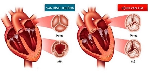 bệnh van tim thường gặp gồm mở không hết (hẹp van) và đóng không kín (hở van)