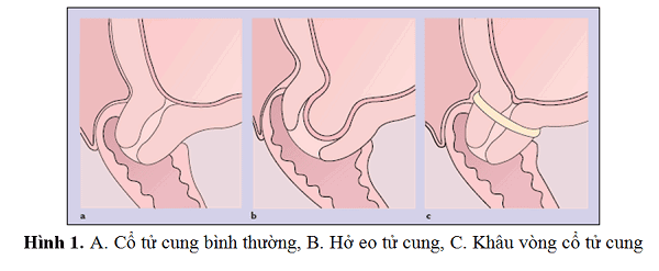 Hở eo tử cung