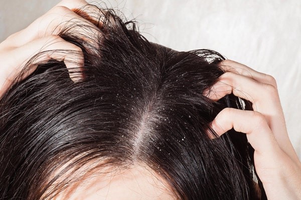Khi gội đầu không dùng dầu gội, tóc bạn dễ bết ngứa và gàu trong giai đoạn đầu
