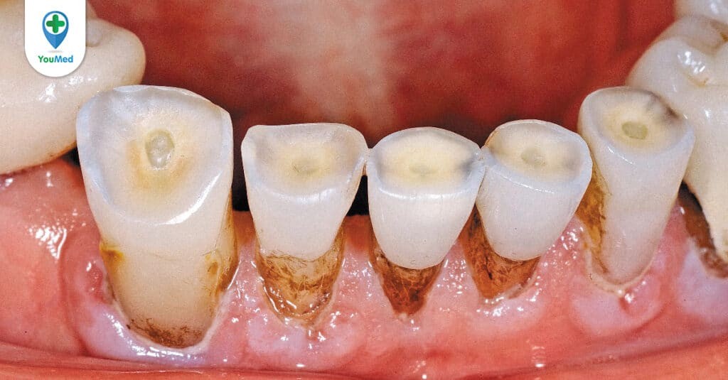 Ngà răng: Thành phần quan trọng của răng