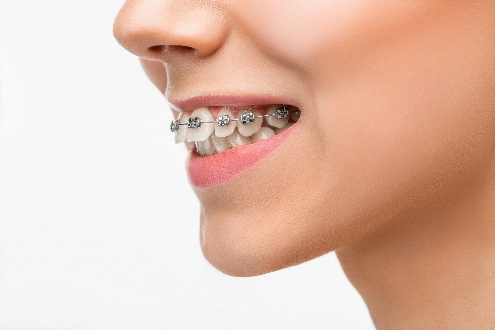 Niềng răng có thể tác động tích cực đến nụ cười của bạn