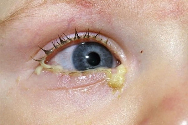 Mắt thường chảy mủ là triệu chứng của tắc tuyến lệ