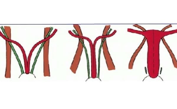 Tử cung đôi xảy ra khi hai ống Muller (màu đỏ) không hoà hợp thành một tử cung