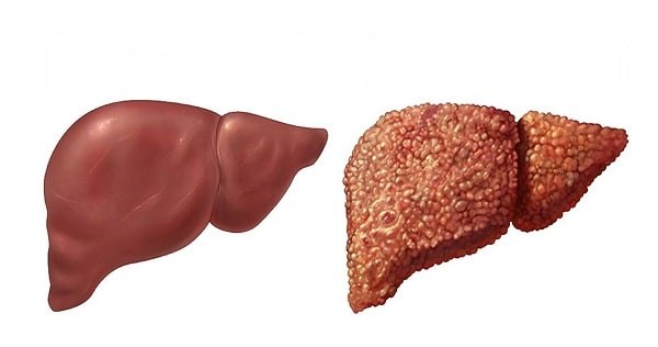 Gan bình thường (bên trái) và gan xơ (bên phải)