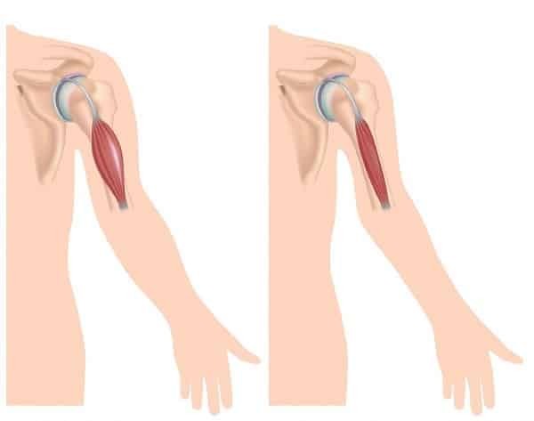 Bên trái là hình ảnh của cơ vùng cánh tay bình thường. Bên phải là hình ảnh cơ trên bệnh nhân loạn dưỡng cơ