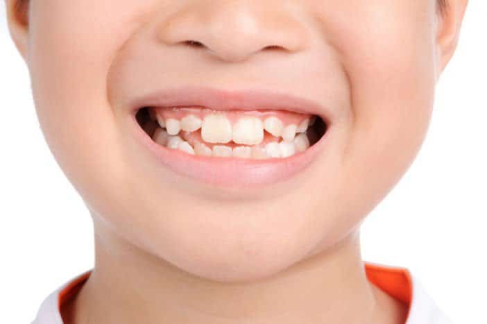 Tình trạng răng mọc lệch ở trẻ em