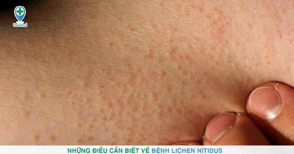 Những điều cần biết về bệnh Lichen nitidus