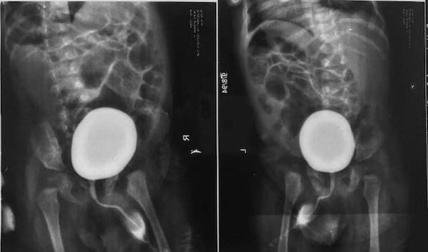 Hình ảnh X-quang bàng quang - niệu đạo khi đi tiểu
