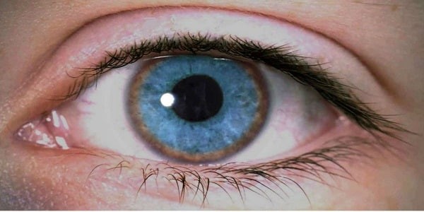 Mắt có vòng của đồng tích tụ ở bệnh Wilson