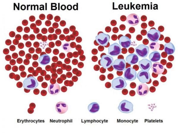 Bệnh Leukemia có thể được điều trị bằng máu cuống rốn