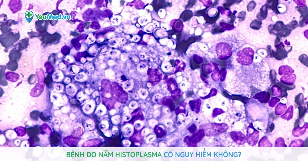Bệnh do nấm histoplasma có nguy hiểm không?