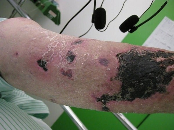 Calciphylaxis-1