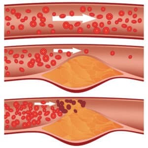 Càng nhiều cholesterol sẽ càng tăng nguy cơ tắc mạch máu