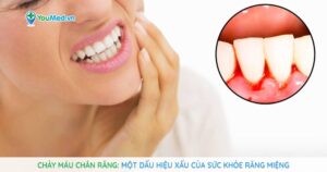 Chảy máu chân răng: Một dấu hiệu xấu của sức khỏe răng miệng