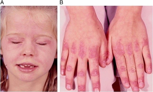 Phát ban ở các đốt ngón tay có thể gặp trong bệnh mô liên kết hỗn hợp