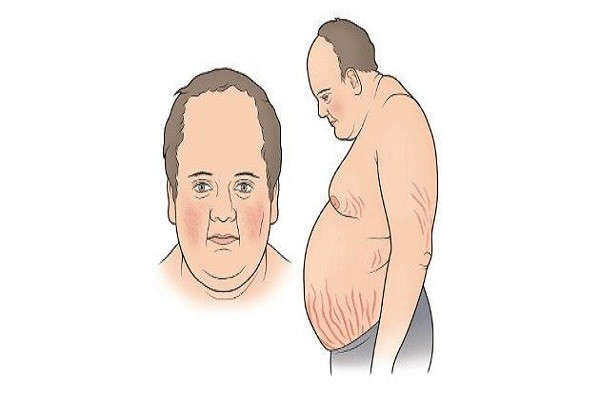 Gương mặt Cushing