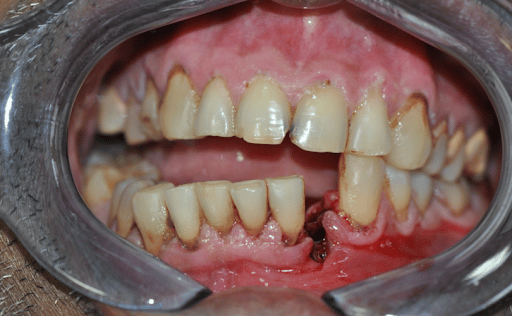 Gãy xương hàm dưới vùng cằm làm gián đoạn cung răng