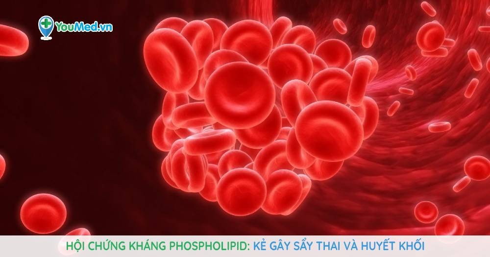 Hội chứng kháng phospholipid: Kẻ gây sẩy thai và huyết khối