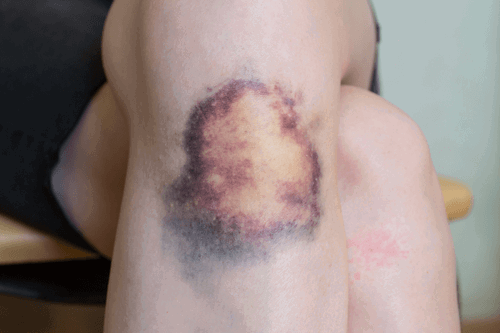 Triệu chứng của hội chứng rối loạn sinh tủy