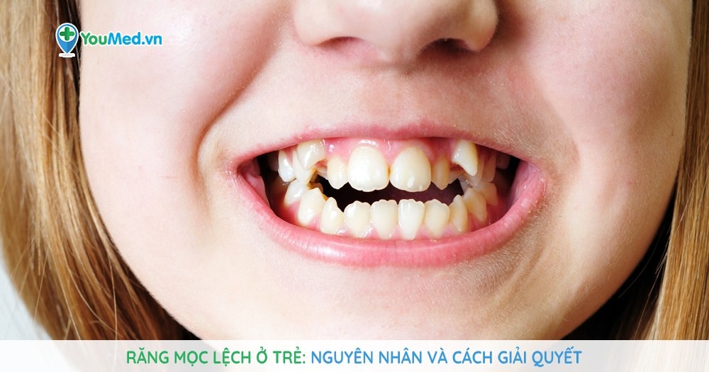 Răng mọc lệch ở trẻ: Nguyên nhân và cách giải quyết