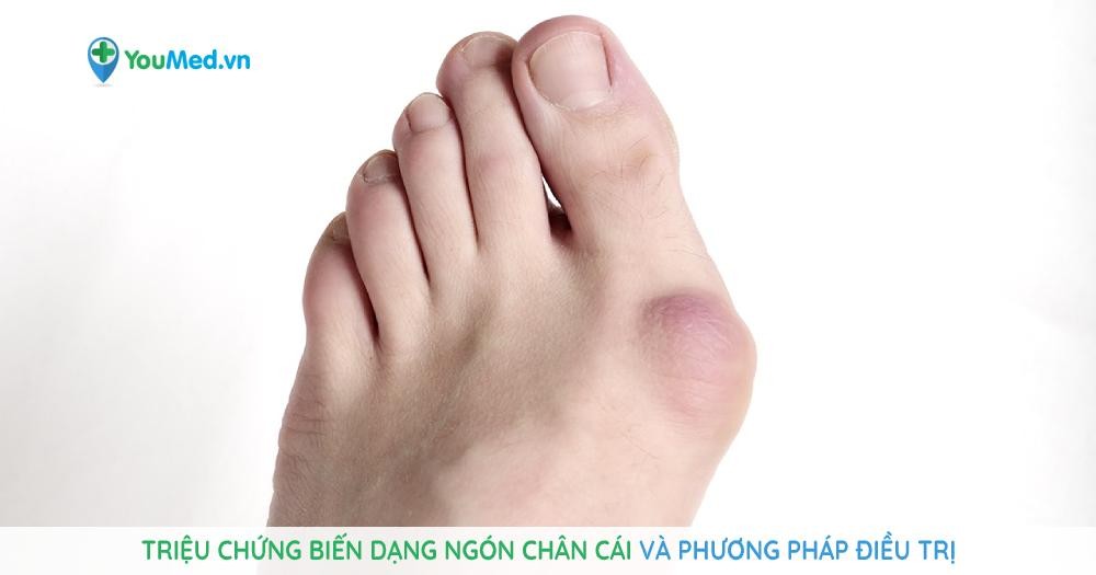 Biến dạng ngón chân cái: triệu chứng, nguyên nhân và phương pháp điều trị