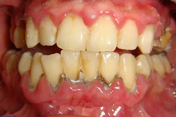 Viêm chân răng là một bệnh lý răng miệng nghiêm trọng