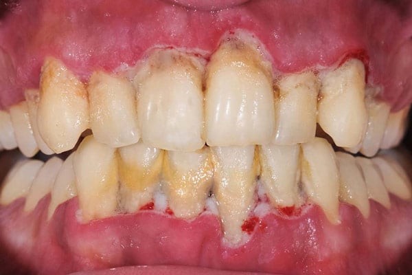 Viêm nướu có thể dẫn đến chảy máu chân răng